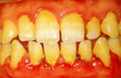 「歯周病」という病気のこと、ご存知ですか？～歯周病治療～